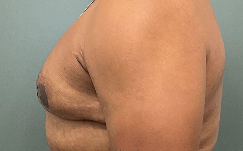 Male Breast Reduction Before & After Gallery - Patient 784376 - Image 4