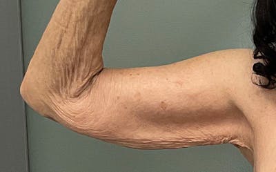 Brachioplasty Before & After Gallery - Patient 411481 - Image 1