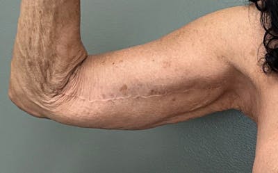 Brachioplasty Before & After Gallery - Patient 411481 - Image 2