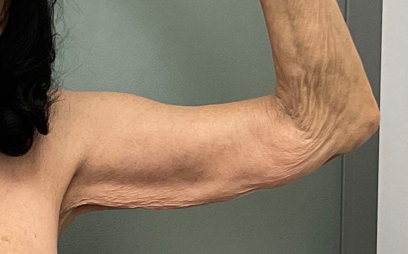 Brachioplasty Before & After Gallery - Patient 411481 - Image 3
