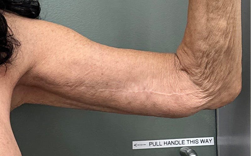 Brachioplasty Before & After Gallery - Patient 411481 - Image 4