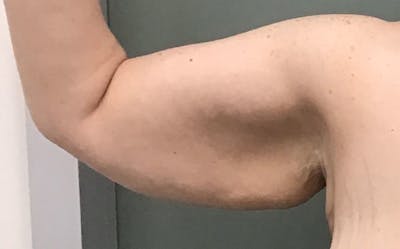 Brachioplasty Before & After Gallery - Patient 143365 - Image 1