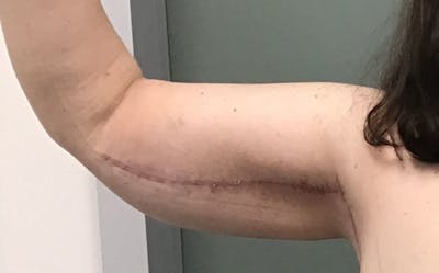 Brachioplasty Before & After Gallery - Patient 143365 - Image 2