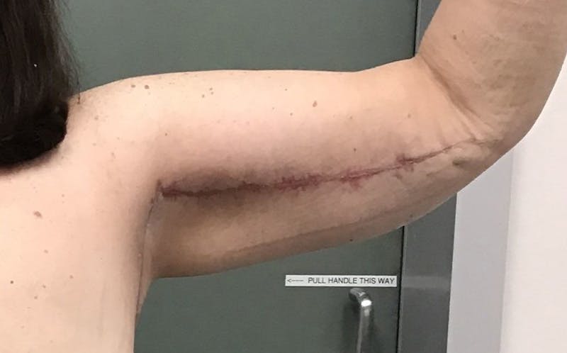 Brachioplasty Before & After Gallery - Patient 143365 - Image 4