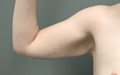 Brachioplasty Before & After Gallery - Patient 213341 - Image 1