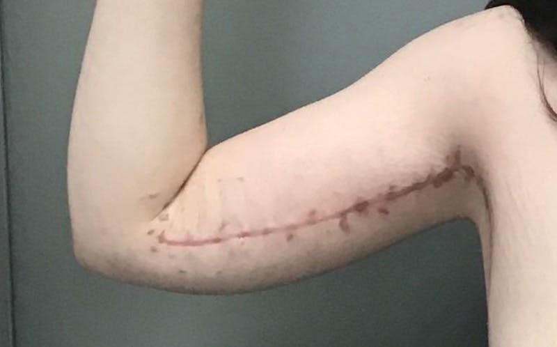 Brachioplasty Before & After Gallery - Patient 213341 - Image 2
