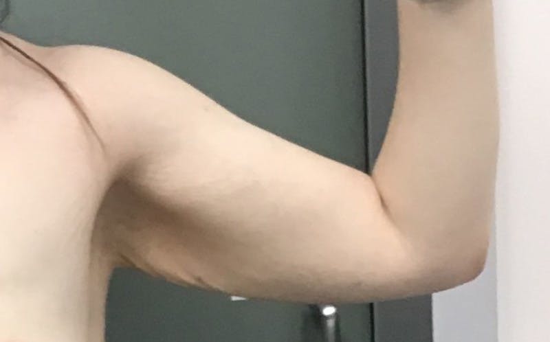 Brachioplasty Before & After Gallery - Patient 213341 - Image 3