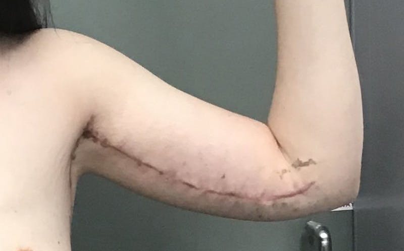 Brachioplasty Before & After Gallery - Patient 213341 - Image 4
