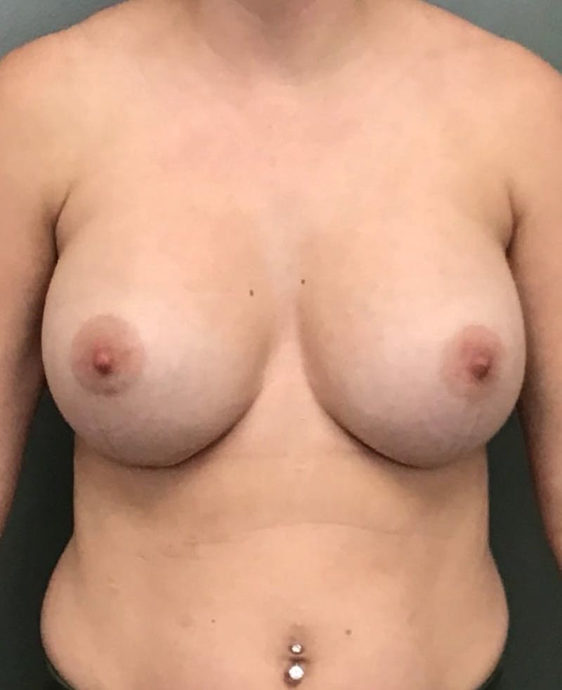 Breast Augmentation Before & After Gallery - Patient 265400 - Image 2