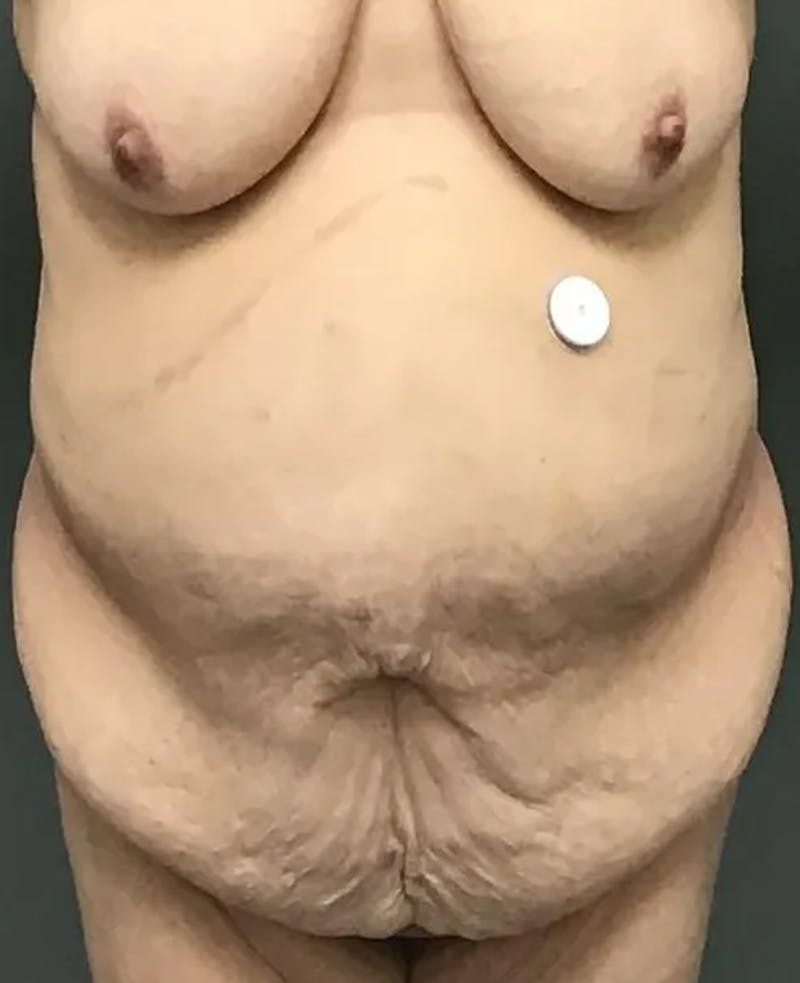 Tummy Tuck Before & After Gallery - Patient 385846 - Image 1