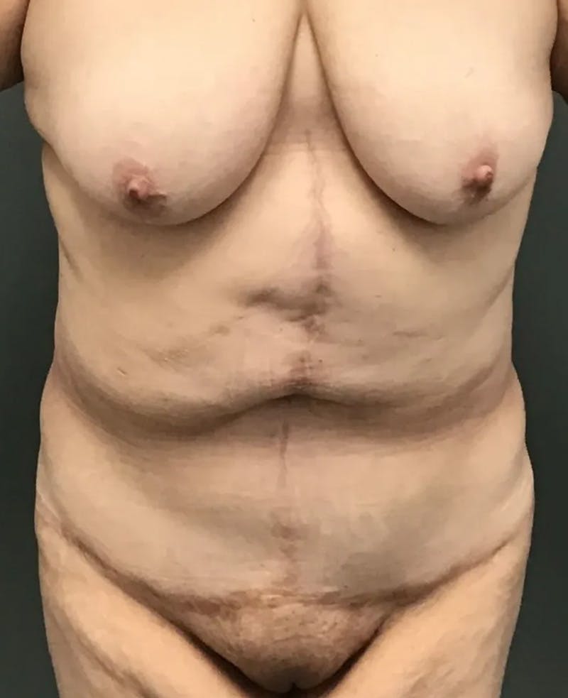Tummy Tuck Before & After Gallery - Patient 385846 - Image 2