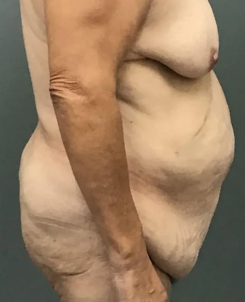 Tummy Tuck Before & After Gallery - Patient 385846 - Image 3