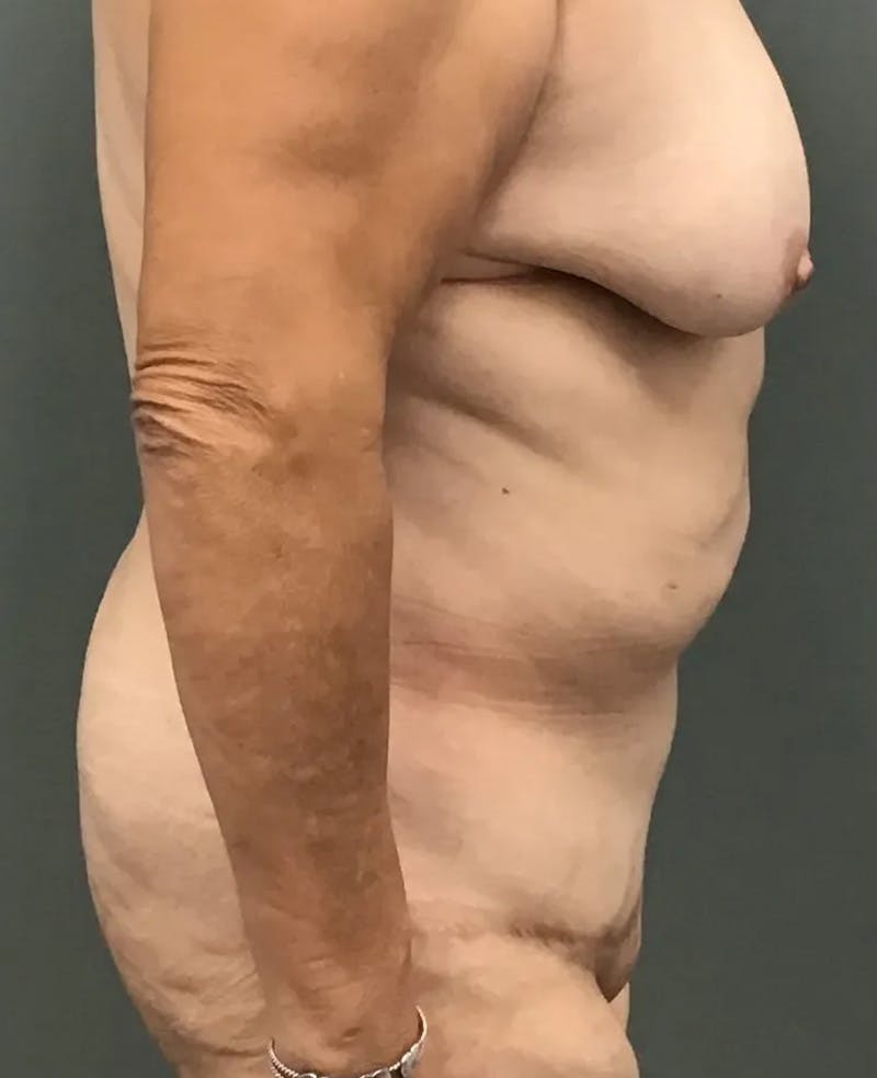 Tummy Tuck Before & After Gallery - Patient 385846 - Image 4