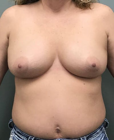 Breast Augmentation Before & After Gallery - Patient 225651 - Image 1