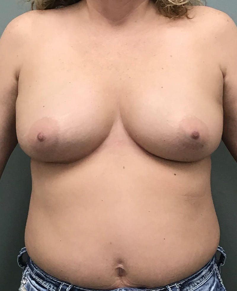 Breast Augmentation Before & After Gallery - Patient 225651 - Image 1