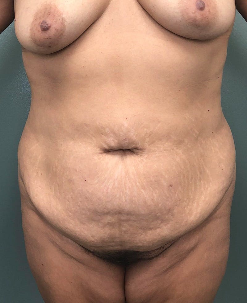 Liposuction Before & After Gallery - Patient 104185 - Image 1