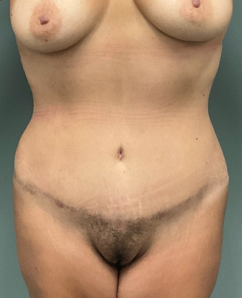 Liposuction Before & After Gallery - Patient 104185 - Image 2