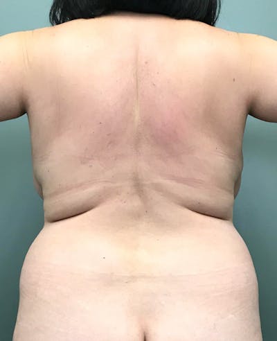 Brazilian Butt Lift Before & After Gallery - Patient 949327 - Image 1