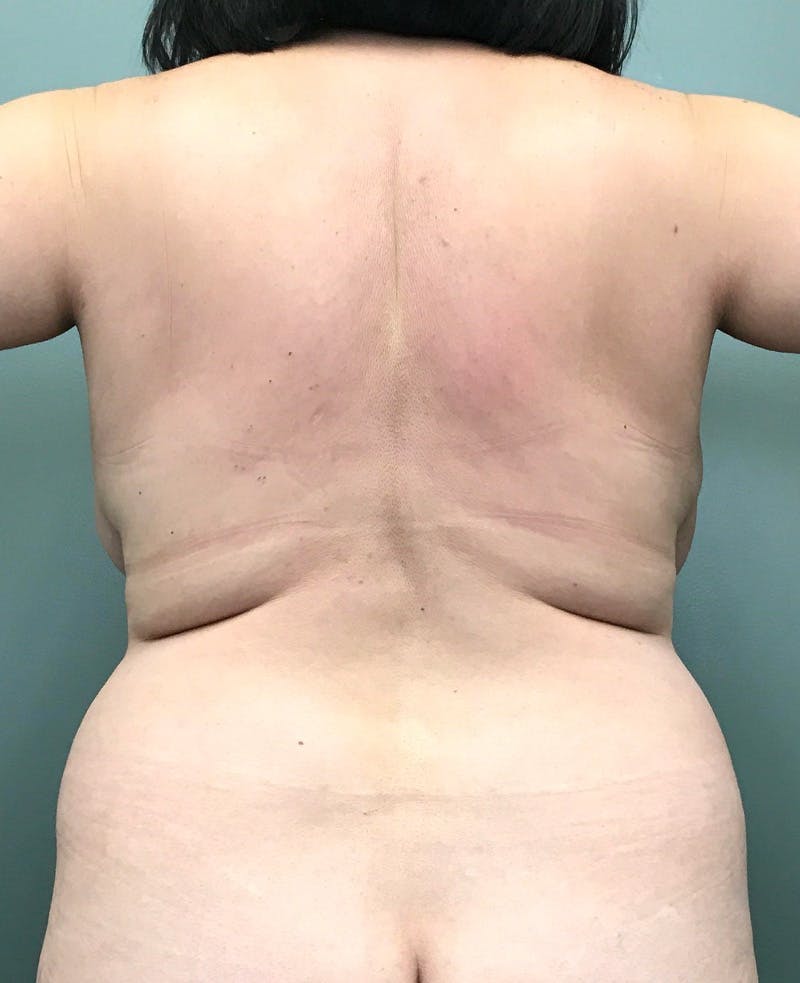 Brazilian Butt Lift Before & After Gallery - Patient 949327 - Image 1