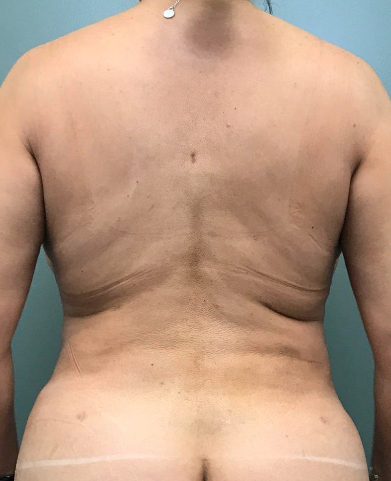 Brazilian Butt Lift Before & After Gallery - Patient 949327 - Image 2