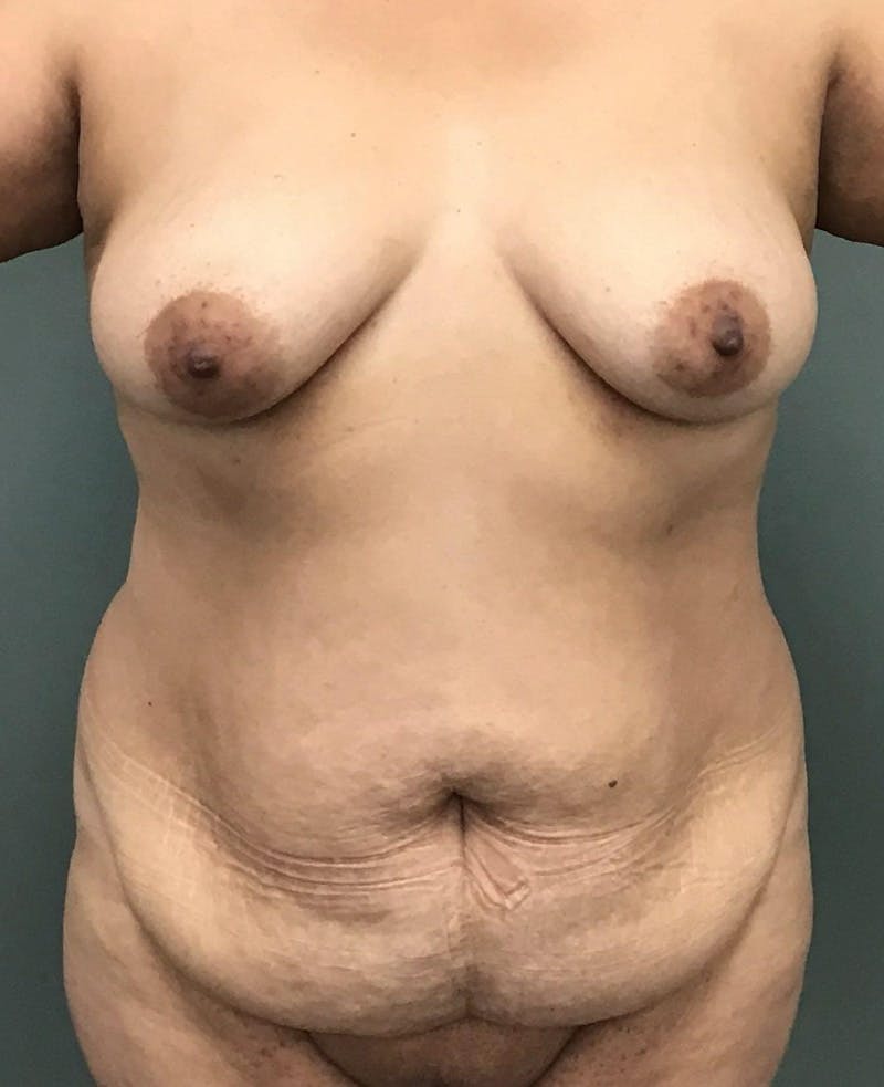 Liposuction Before & After Gallery - Patient 201862 - Image 1