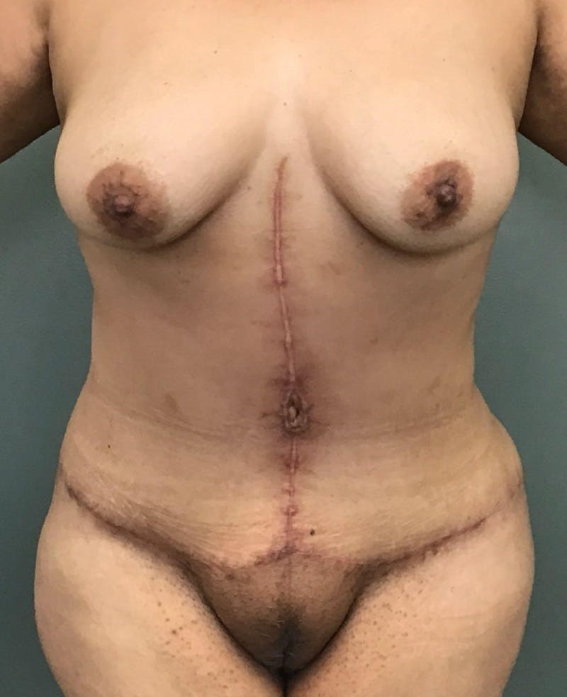 Liposuction Before & After Gallery - Patient 201862 - Image 2