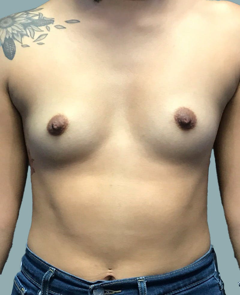 Breast Augmentation Before & After Gallery - Patient 285734 - Image 1