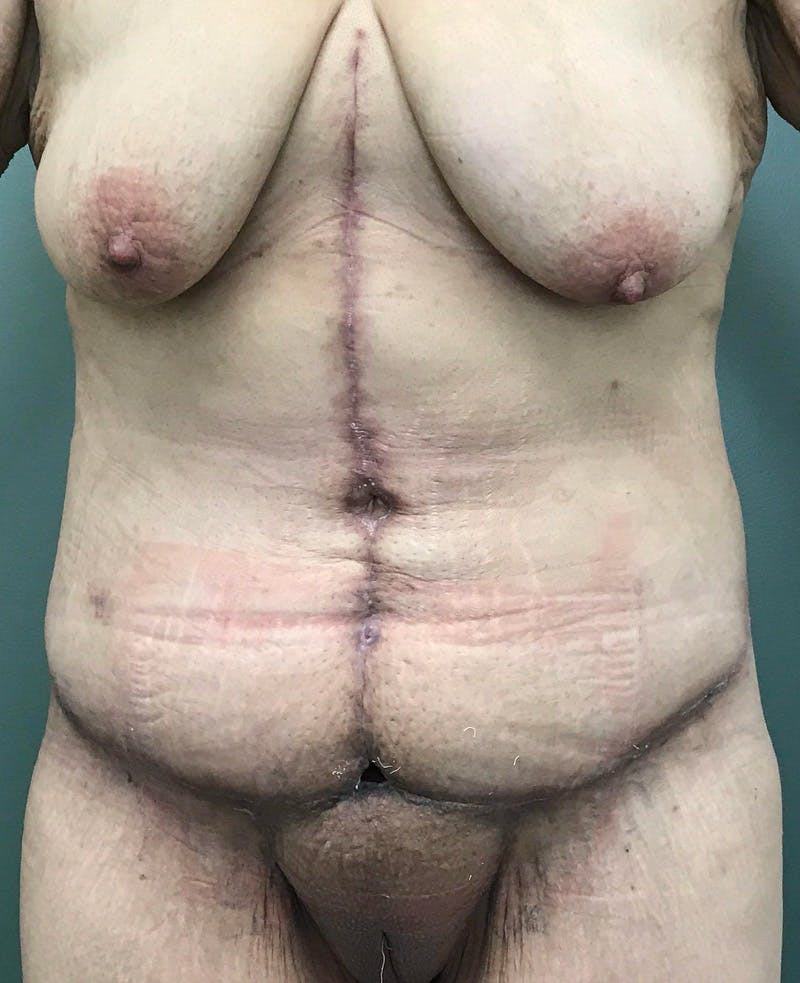 Tummy Tuck Before & After Gallery - Patient 770532 - Image 2