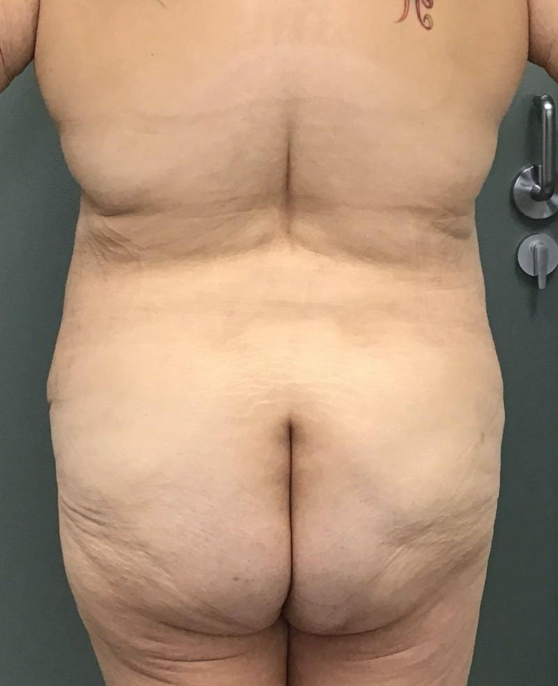 Tummy Tuck Before & After Gallery - Patient 770532 - Image 3