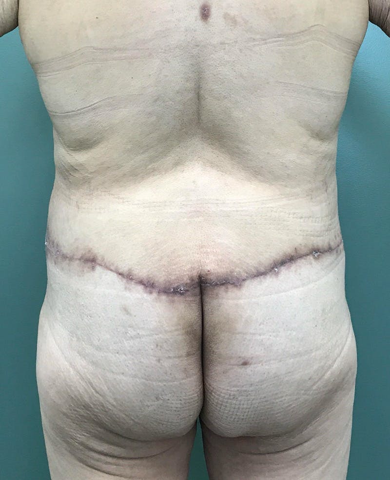 Tummy Tuck Before & After Gallery - Patient 770532 - Image 4