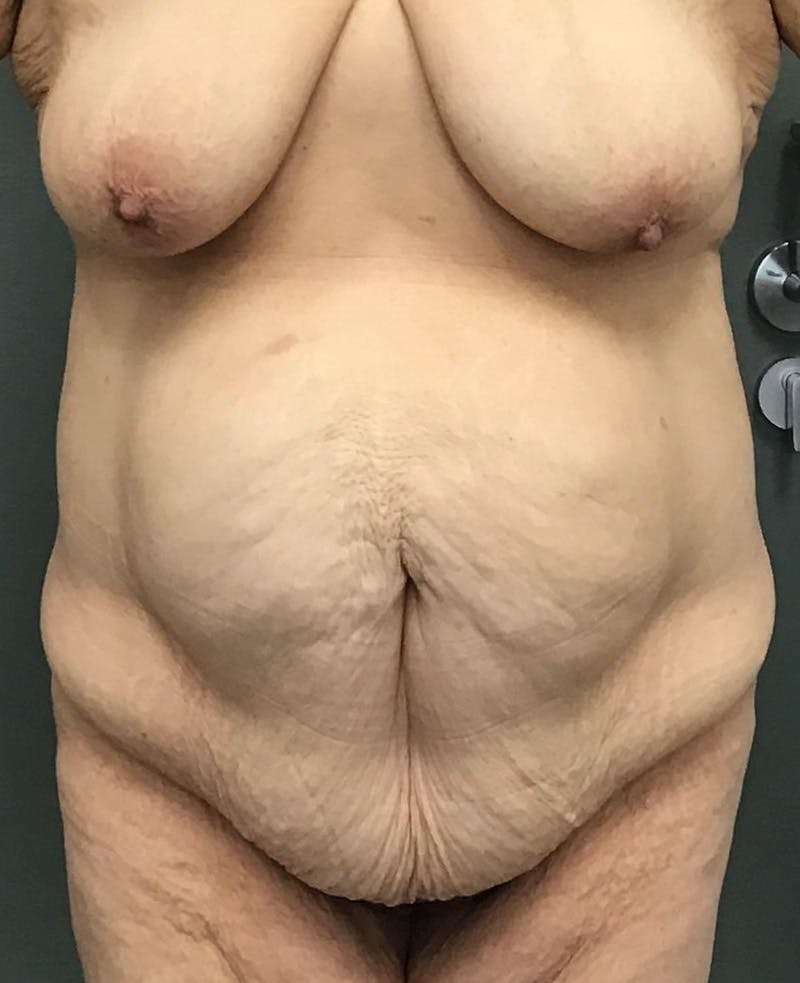 Tummy Tuck Before & After Gallery - Patient 770532 - Image 1