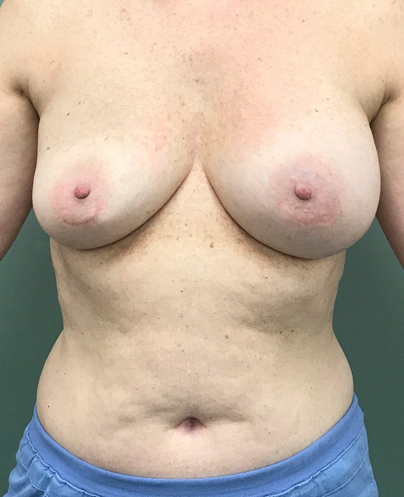 Breast Augmentation Before & After Gallery - Patient 165318 - Image 1