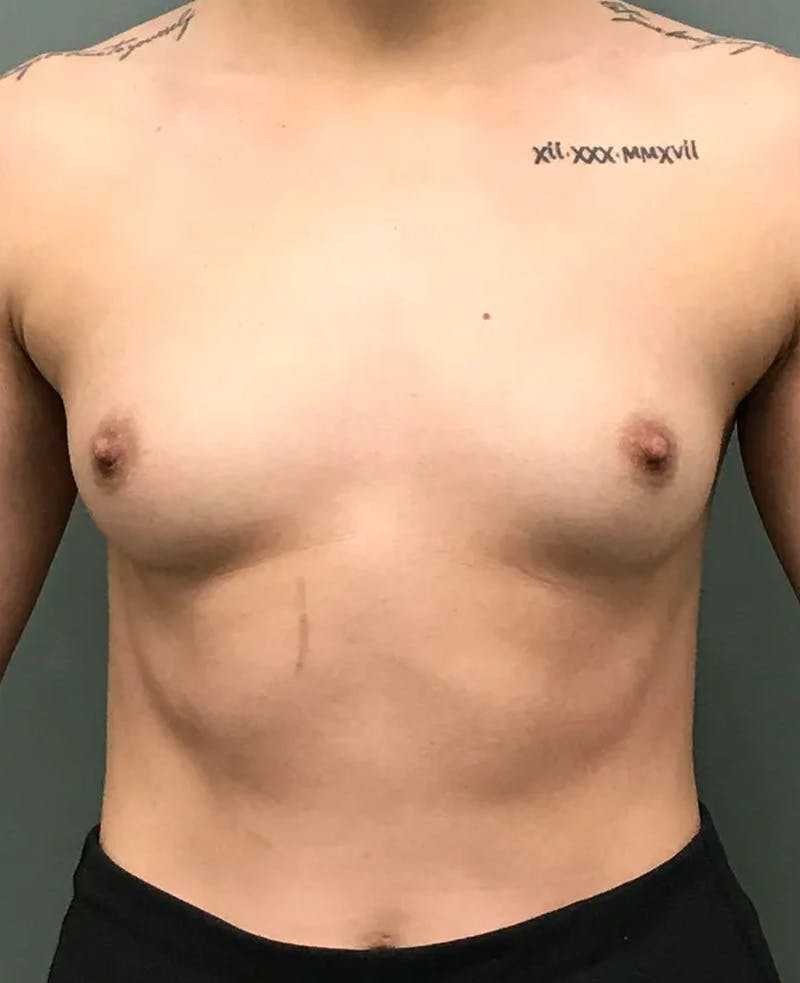 Breast Augmentation Before & After Gallery - Patient 167325 - Image 1