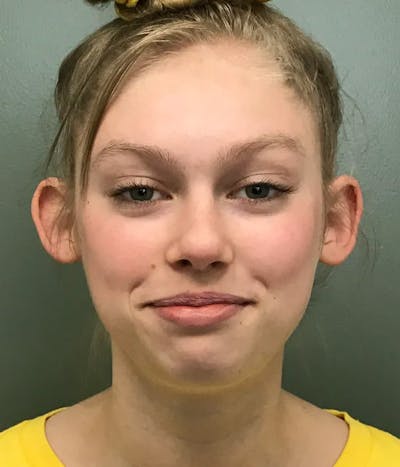 Otoplasty Before & After Gallery - Patient 397903 - Image 1