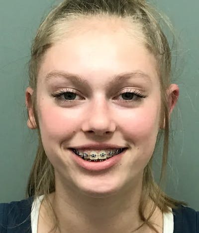 Otoplasty Before & After Gallery - Patient 397903 - Image 2