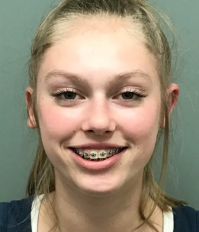 Otoplasty Before & After Gallery - Patient 397903 - Image 2