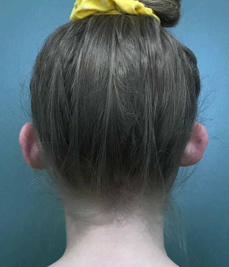 Otoplasty Before & After Gallery - Patient 397903 - Image 3