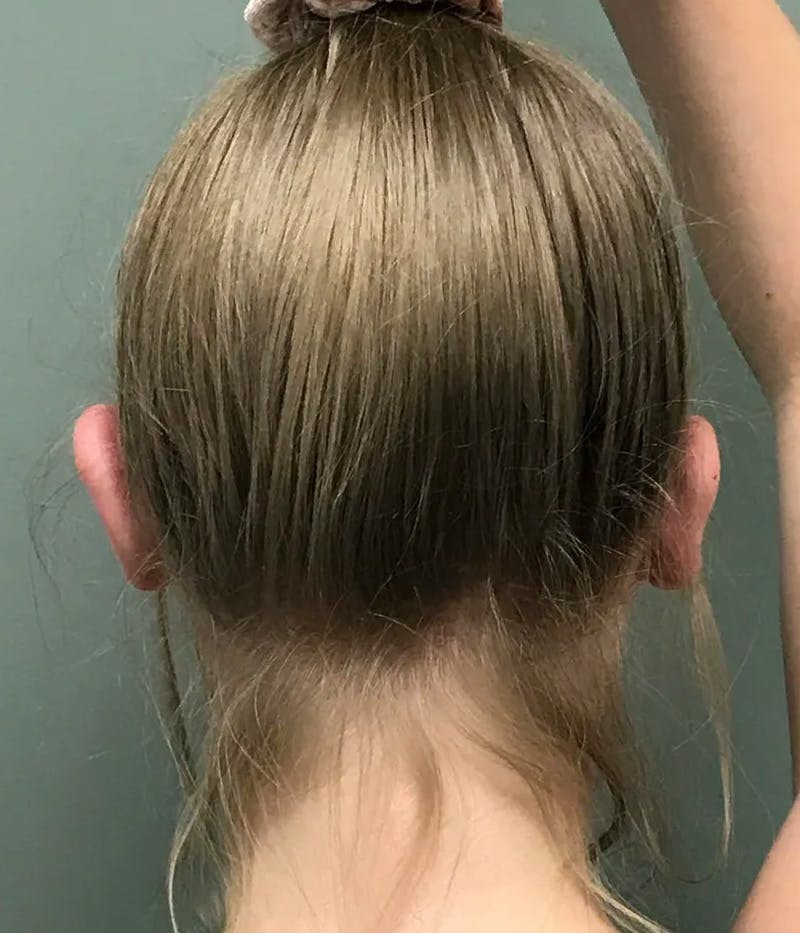 Otoplasty Before & After Gallery - Patient 397903 - Image 4