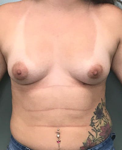 Breast Augmentation Before & After Gallery - Patient 191030 - Image 1
