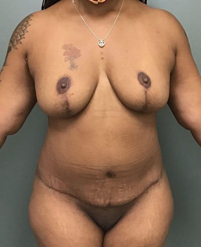 Tummy Tuck Before & After Gallery - Patient 183085 - Image 2