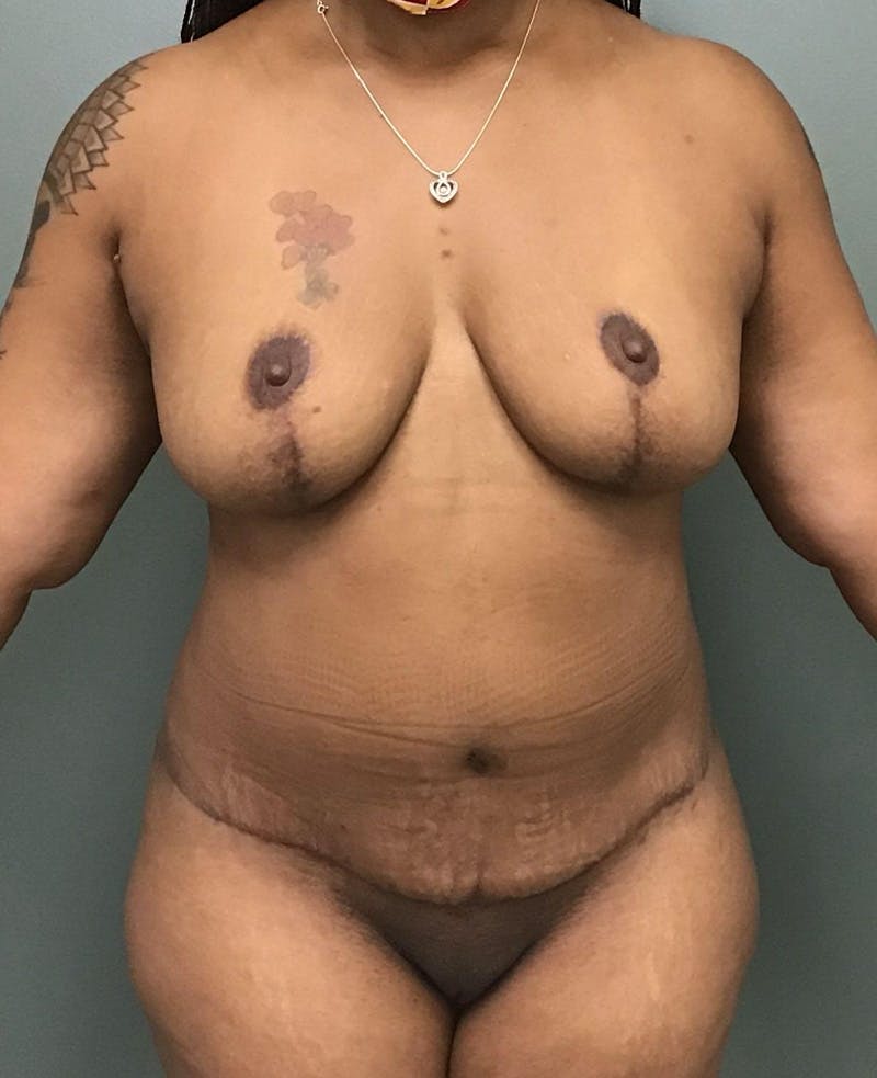 Liposuction Before & After Gallery - Patient 177338 - Image 2