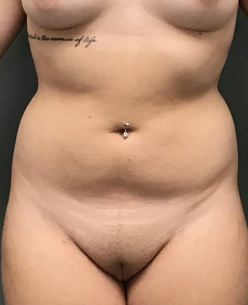 Liposuction Before & After Gallery - Patient 148470 - Image 1