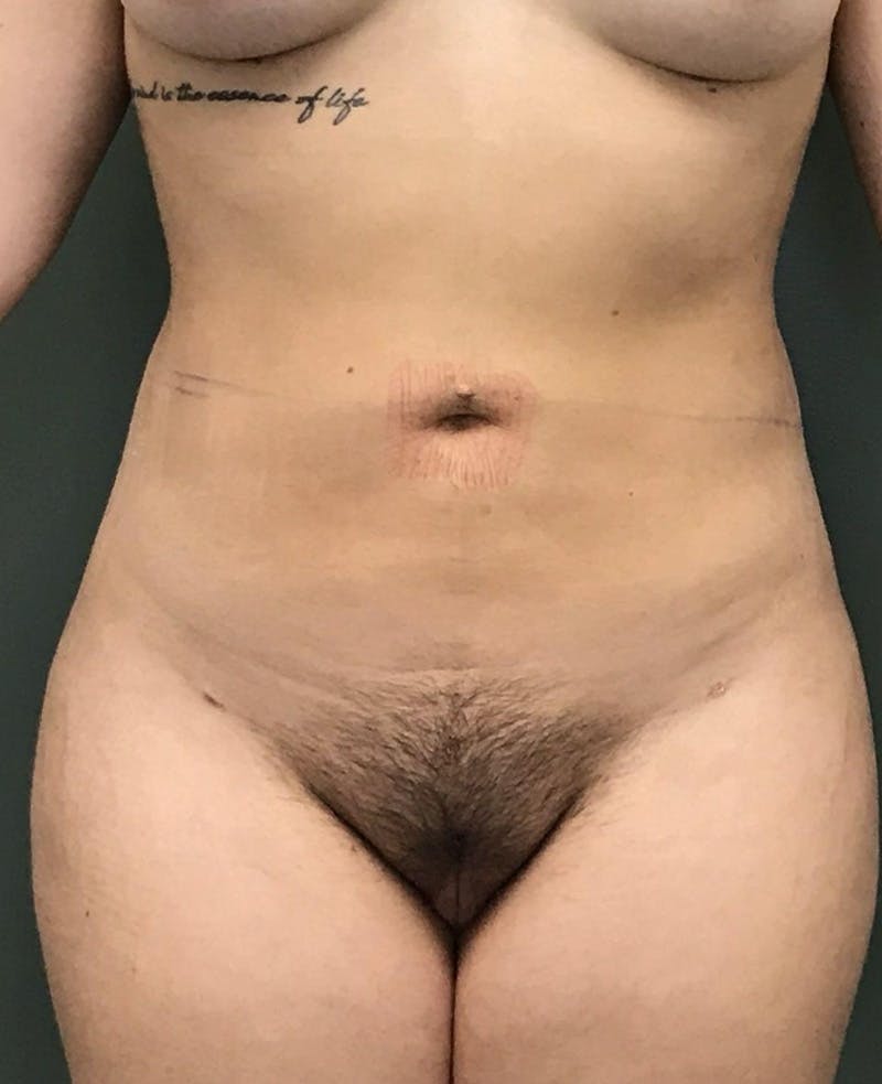 Liposuction Before & After Gallery - Patient 148470 - Image 2