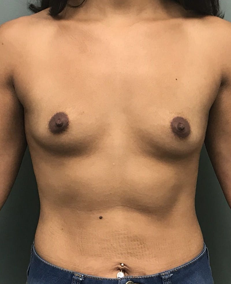 Breast Augmentation Before & After Gallery - Patient 424788 - Image 1