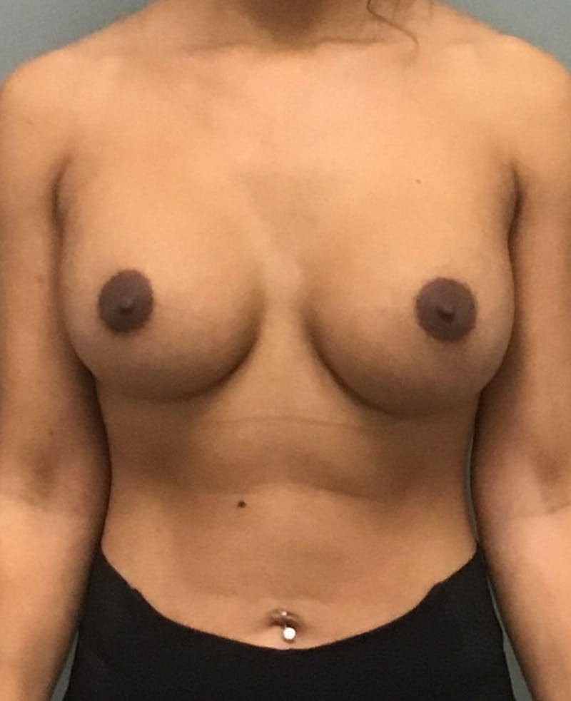 Breast Augmentation Before & After Gallery - Patient 424788 - Image 2