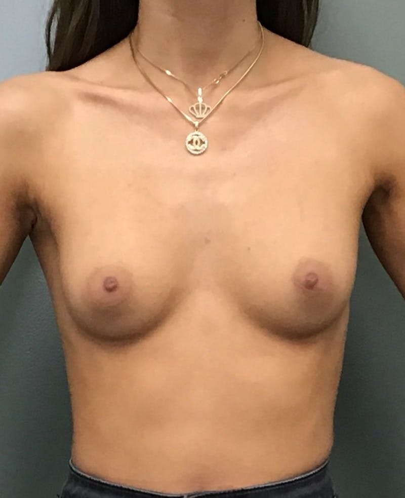 Breast Augmentation Before & After Gallery - Patient 113349 - Image 1