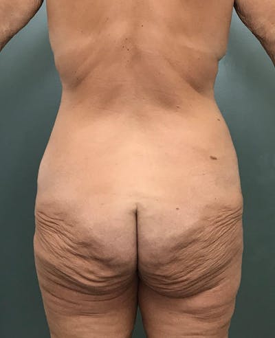 Brazilian Butt Lift Before & After Gallery - Patient 129268 - Image 1
