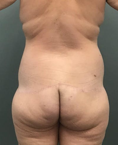 Brazilian Butt Lift Before & After Gallery - Patient 129268 - Image 2