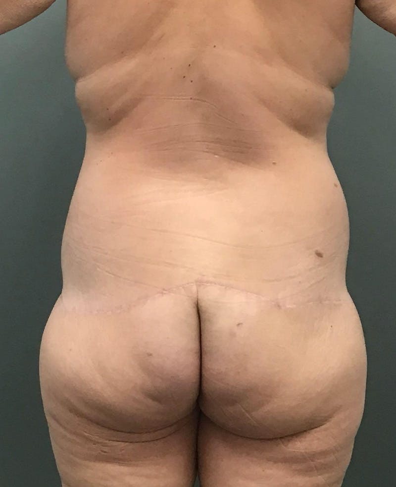 Body Contouring Before & After Gallery - Patient 127427 - Image 4