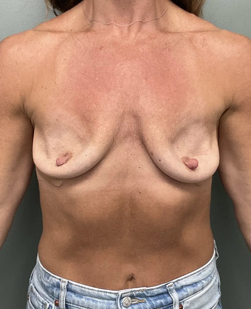 Breast Implant Removal Before & After Gallery - Patient 418075 - Image 1